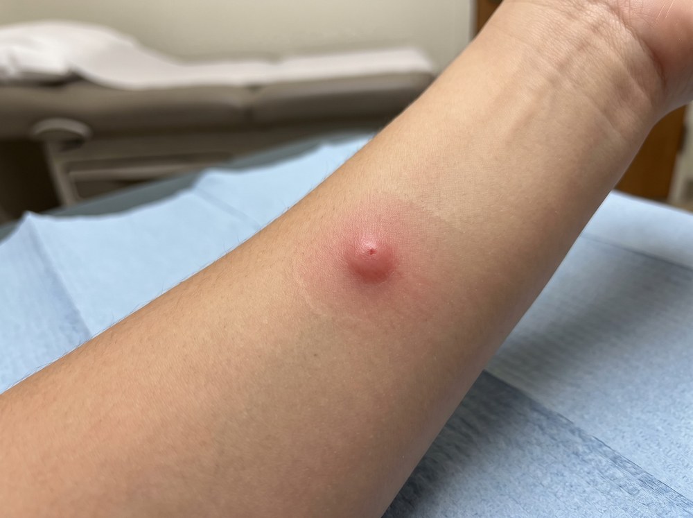 Close-up photo of a single raised red welt from a harvester ant sting with mild swelling on pale skin