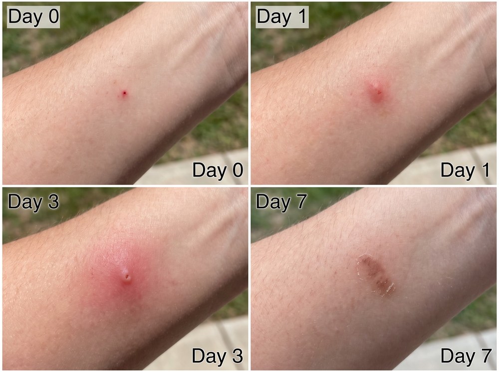 Side-by-side labeled comparison photo of a harvester ant sting welt next to a cluster of fire ant sting pustules